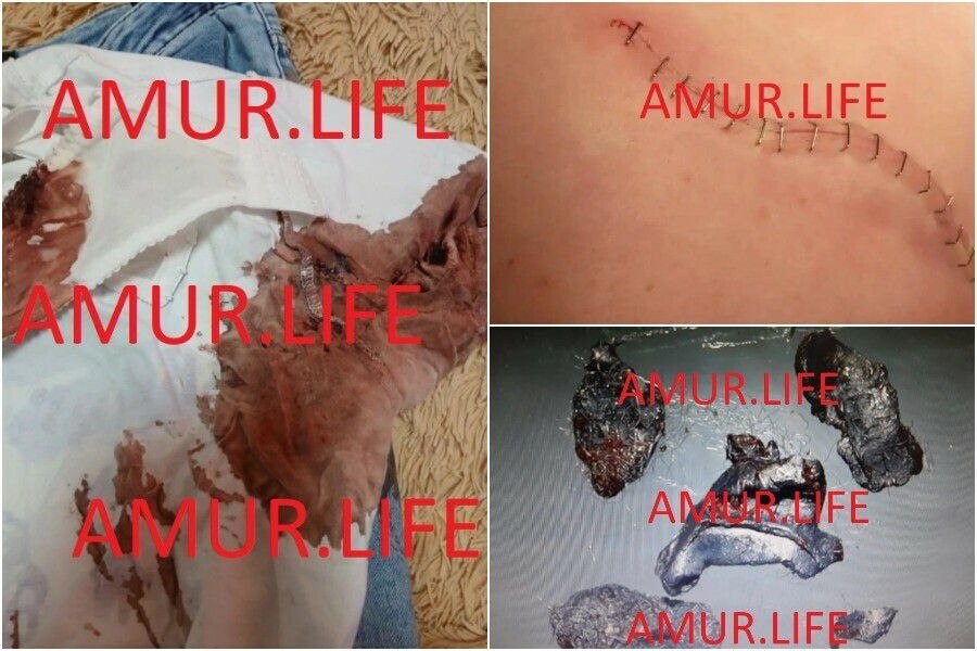 «Ребенку сделали уже три операции»: школьница, которую в Свободном ранил из ружья бизнесмен, до сих пор не оправилась от случившегося