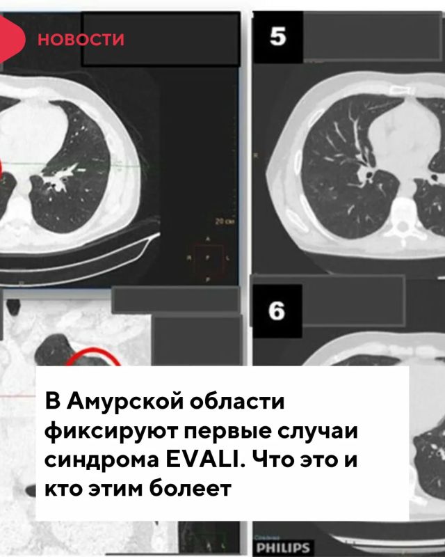 В Приамурье зафиксированы первые случаи новой угрозы – синдрома EVALI