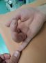 Один палец из двух собрали амурские хирурги